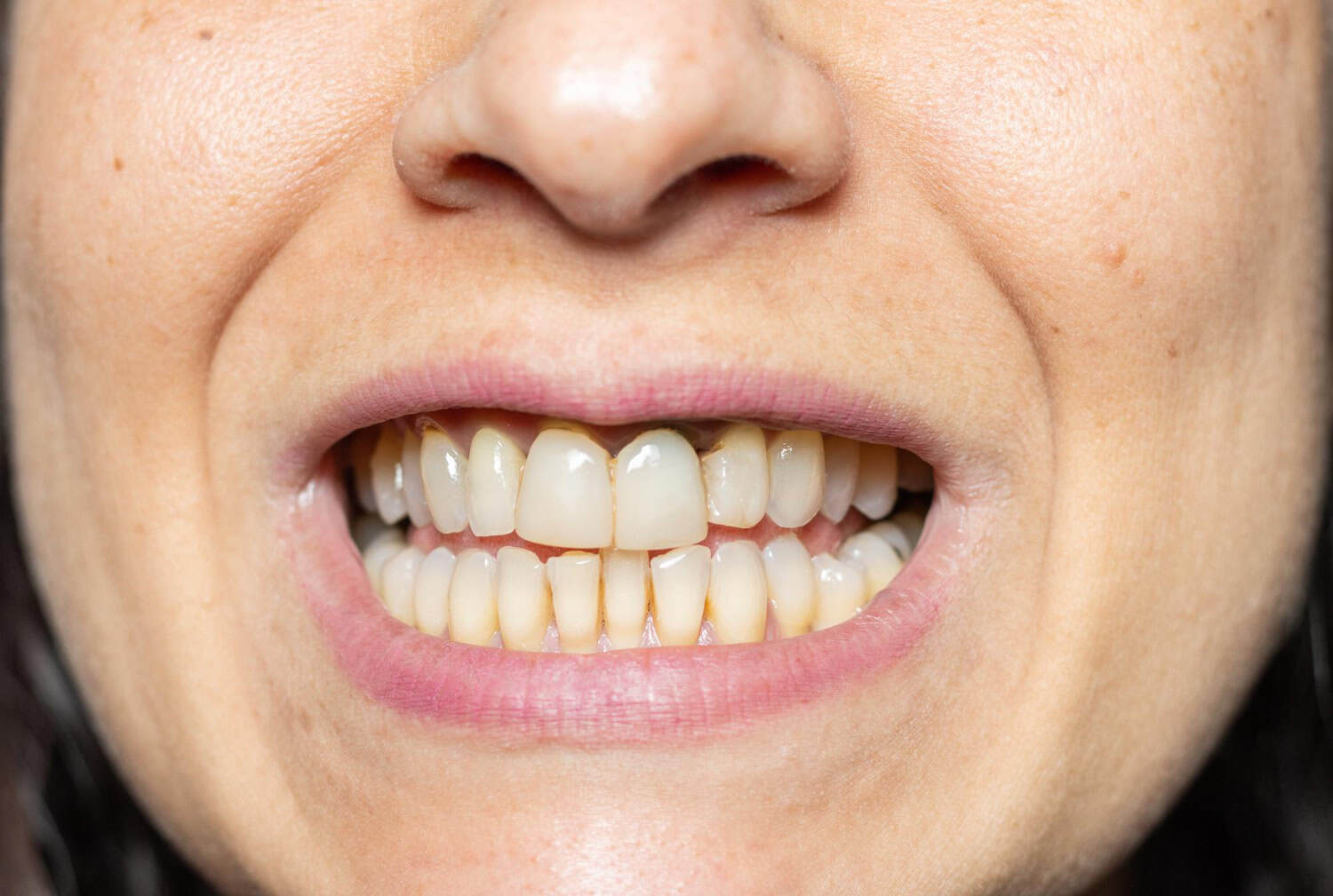 Close-up of a woman smiling and showing her front teeth and gums.