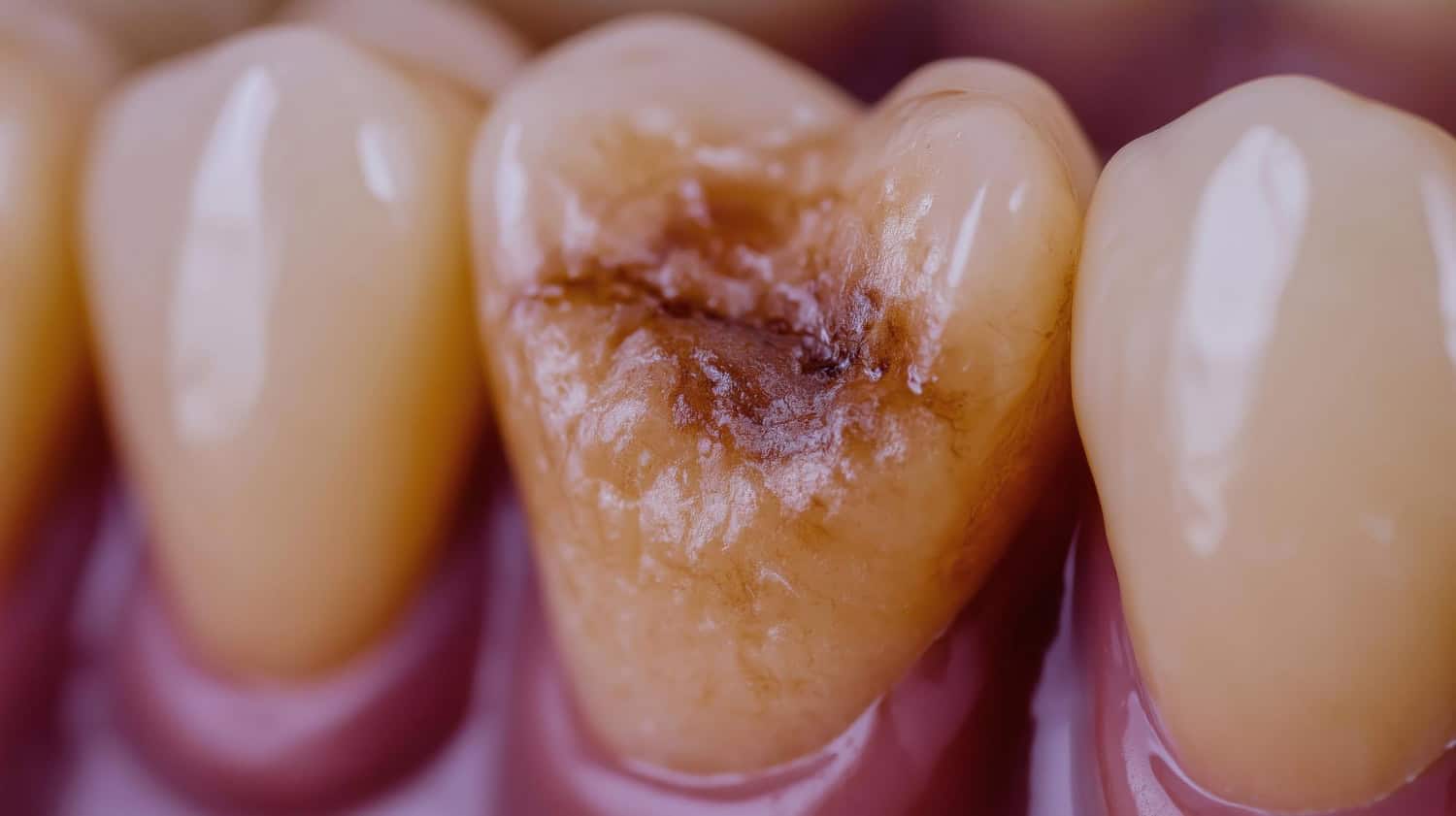Damaged tooth with visible decay between healthy teeth requiring dental crown replacement in Westford, MA.