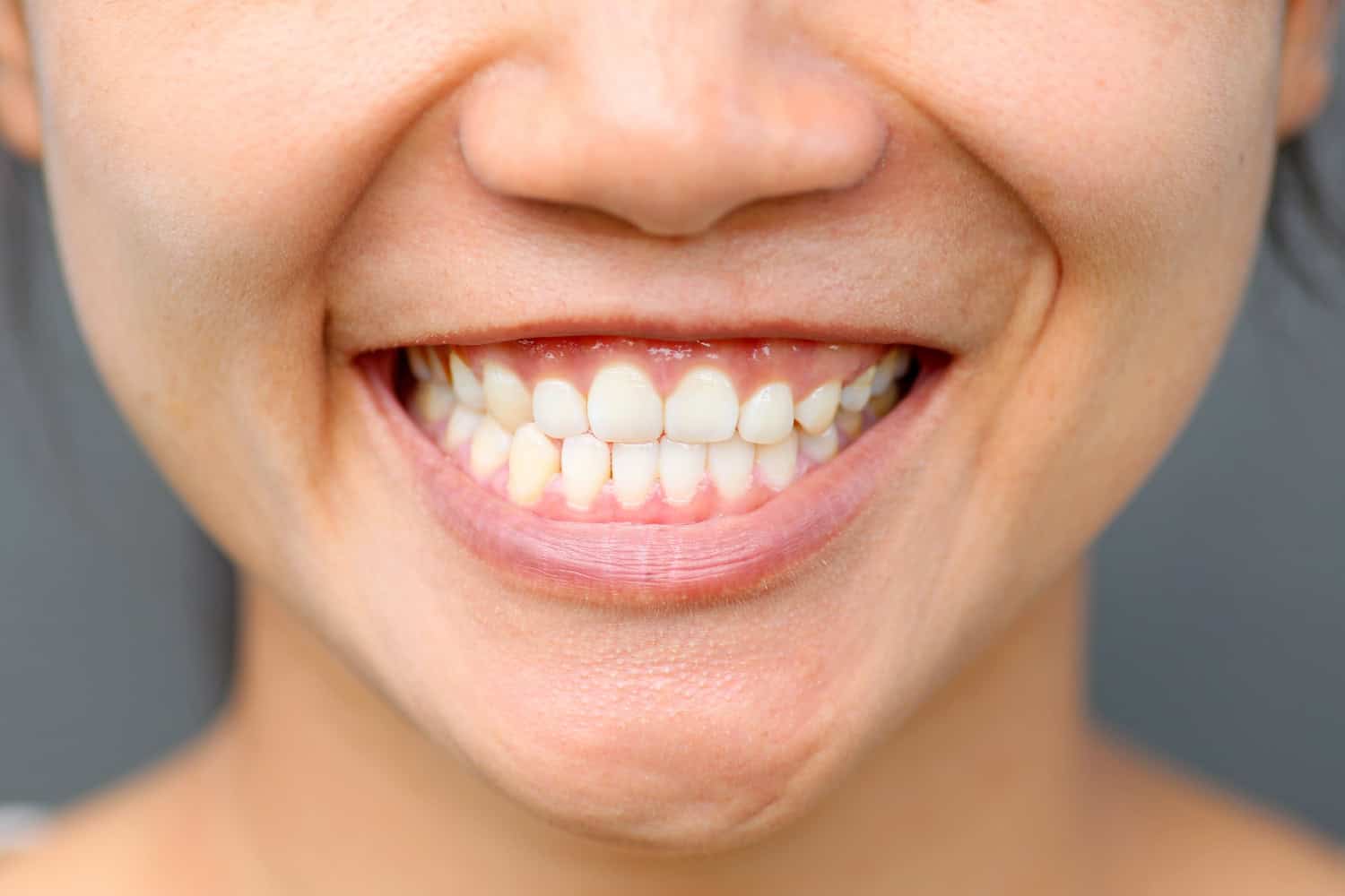 Close-up of a smiling patient showing an overbite with upper front teeth overlapping the lower teeth.