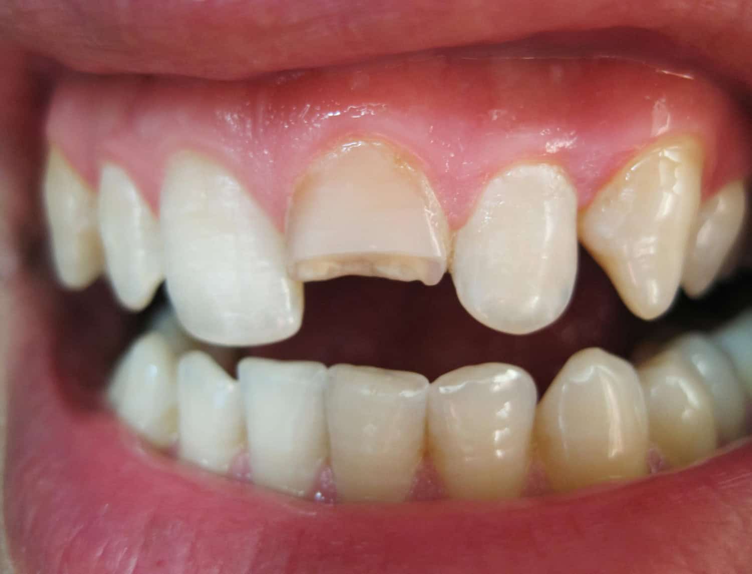 Damaged dental crown showing visible wear and a fractured edge as a sign of crown failure over time and tooth damage.