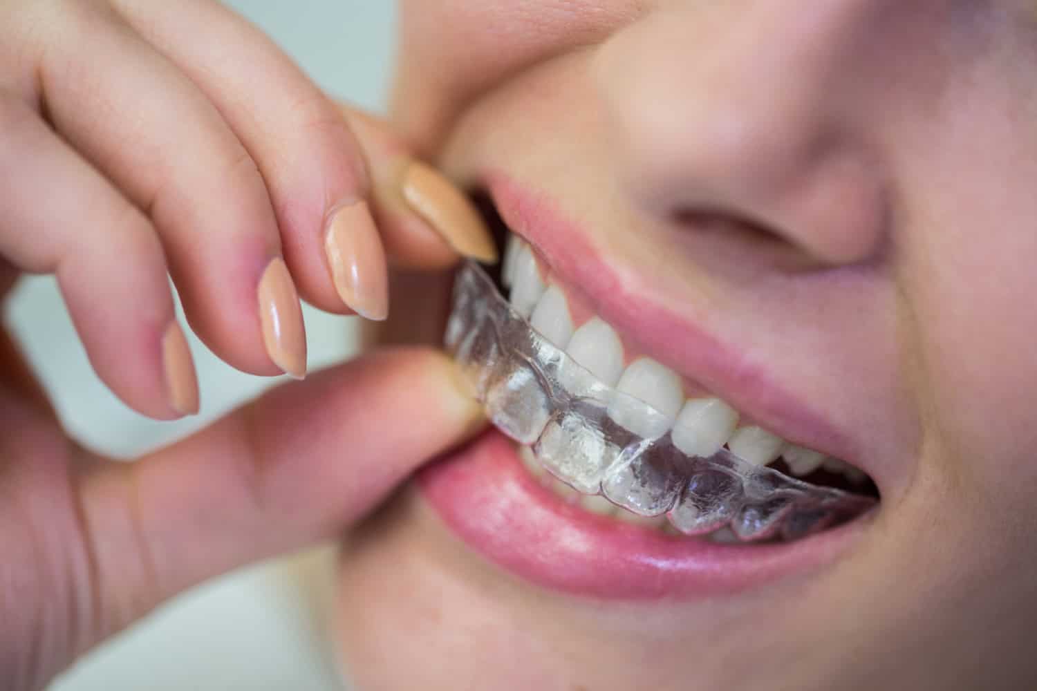 Close-up of a patient wearing clear aligners designed to gradually straighten the teeth.